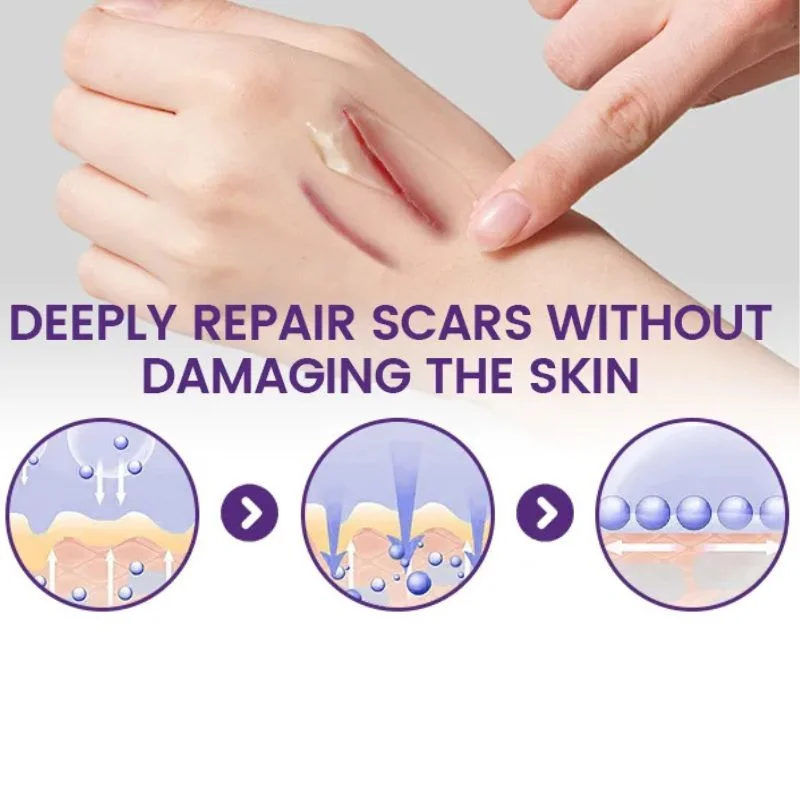 TIMILK Scarvanisher Scar Gel 30g | Advanced Scar & Stretch Marks Removal Cream | Fast-Absorbing Skin Repair Gel - Image 2